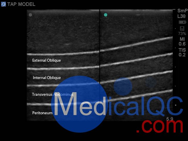 BP2001-TAP腹橫肌超聲訓(xùn)練模型,BP2001-TAP腹橫肌超聲模體