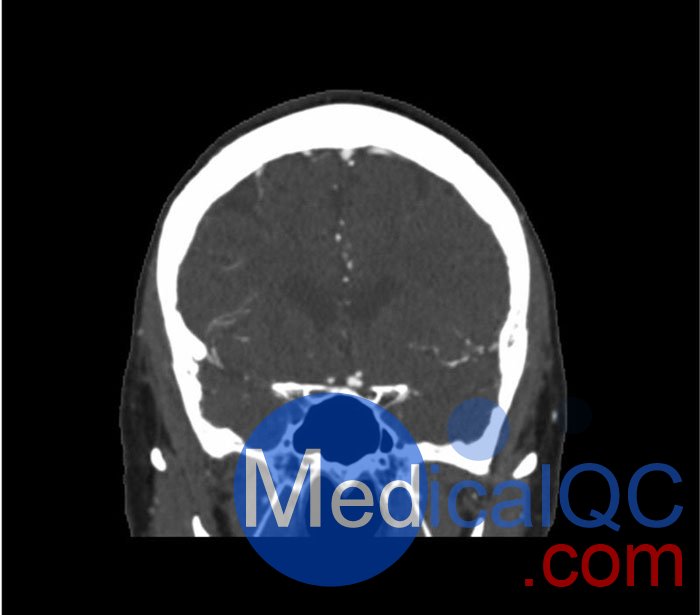 WEK50-03動脈瘤頭模,WEK50-03血管造影CTA頭模影像圖