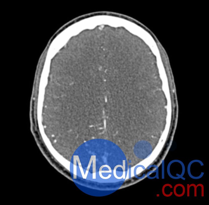 WEK50-04 CTA頭模，帶AVM CTA頭模，WEK50-04 CT血管造影頭模成像效果圖
