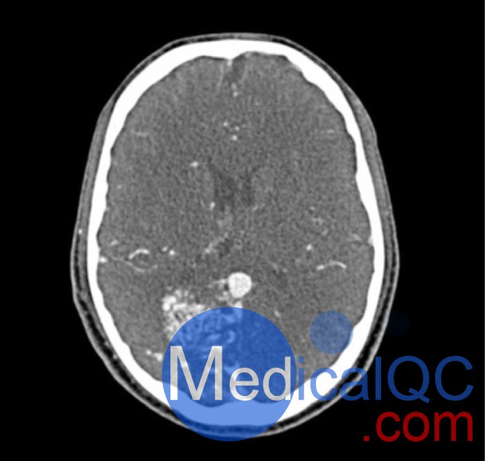 WEK-5005腦血管造影頭模，WEK-5005頭模， CTA AVM頭模成像效果圖
